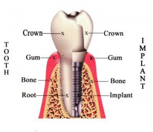 dental implant ahmedabad