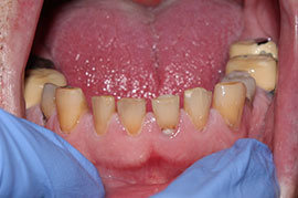 Cosmetic Treatment of Teeth In Ahmedabad