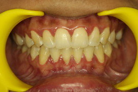 Periodontal Disease